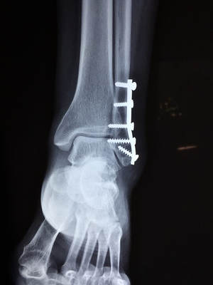 X-ray of a foot and ankle following surgery with pins who would receive physiotherapy treatment at Function Physiotherapy
