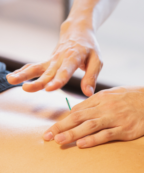 Person receiving dry needling treatment